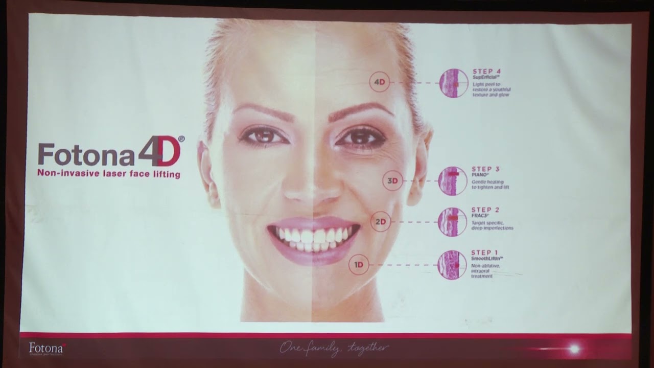 Asian View et optimisation des protocoles laser avec Fotona SP Dynamis et StarWalker – Dr Lucas Chia