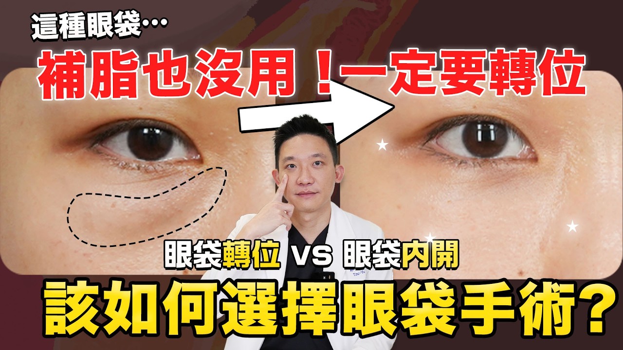 2025更新︎︎✨一次了解眼袋轉位！適合誰？跟內開不同？能合併補脂？林子宇醫師の眼袋手術大全最新版｜依心唯美 林子宇醫師