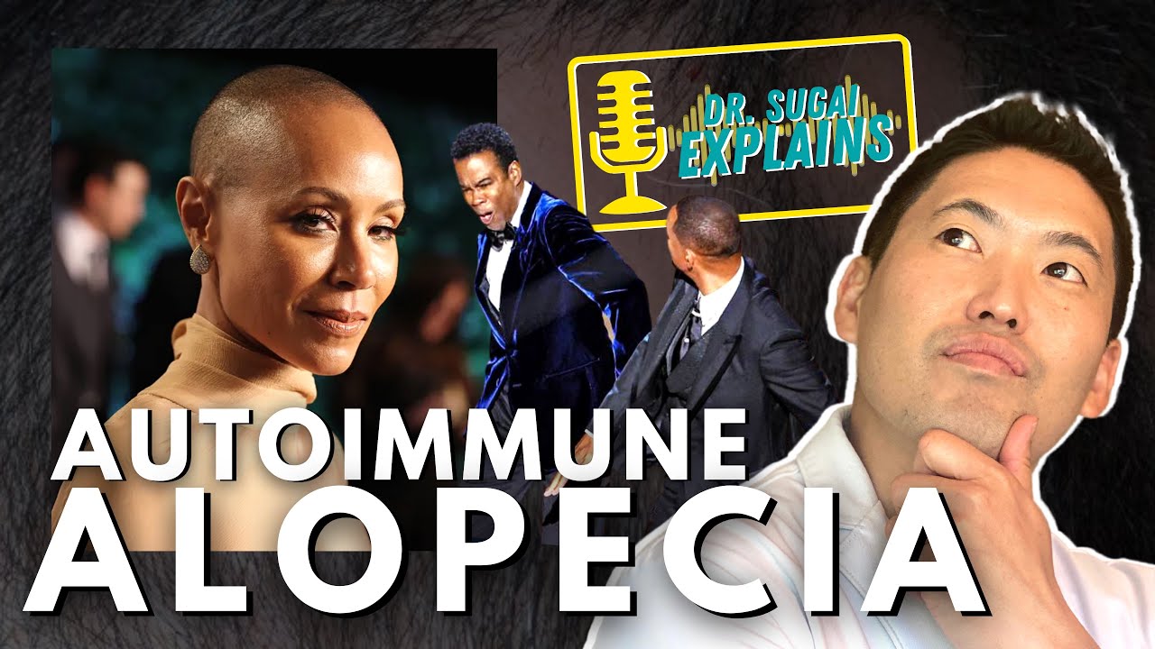 Dermatologist Explains: Autoimmune Alopecia (Alopecia areata)