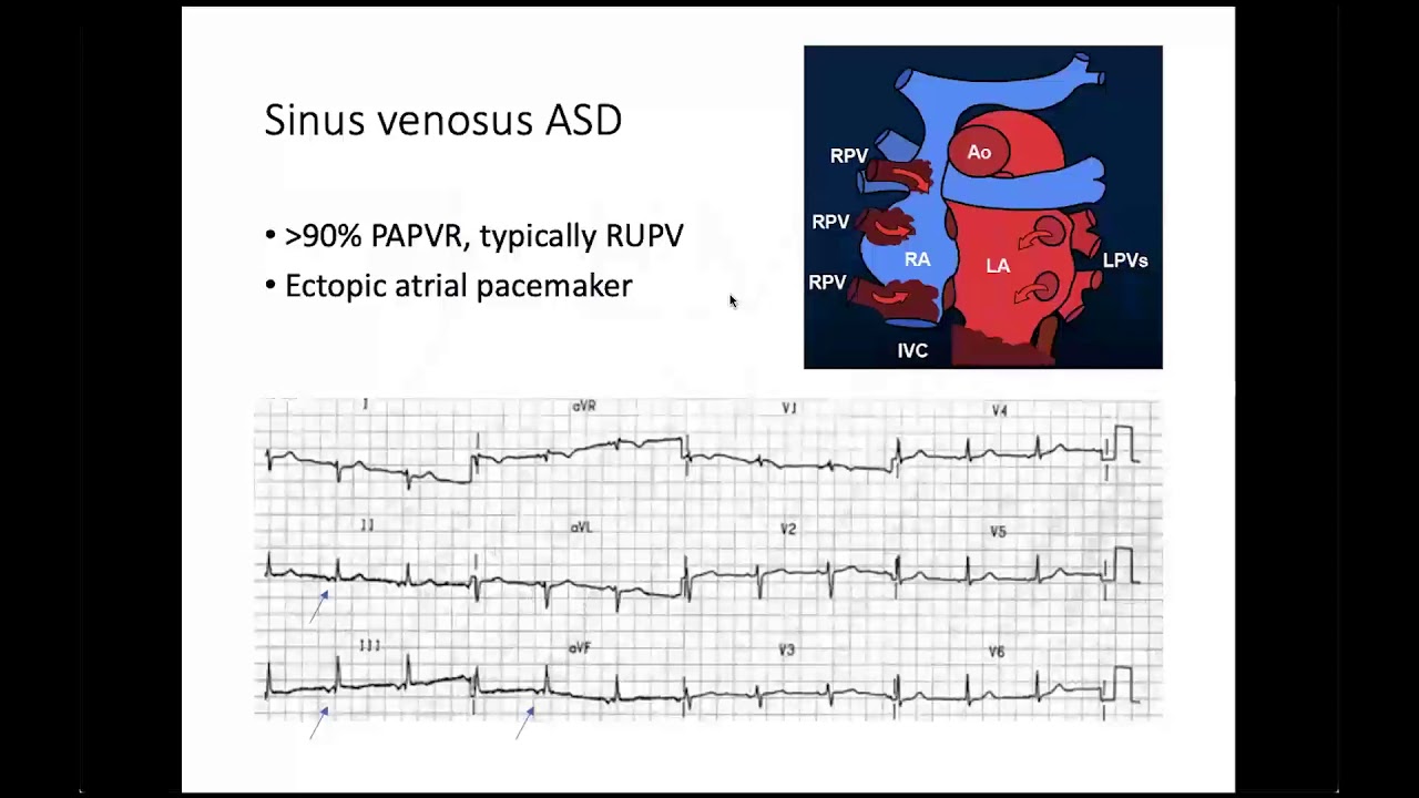 Atrial Septal Abnormalities
