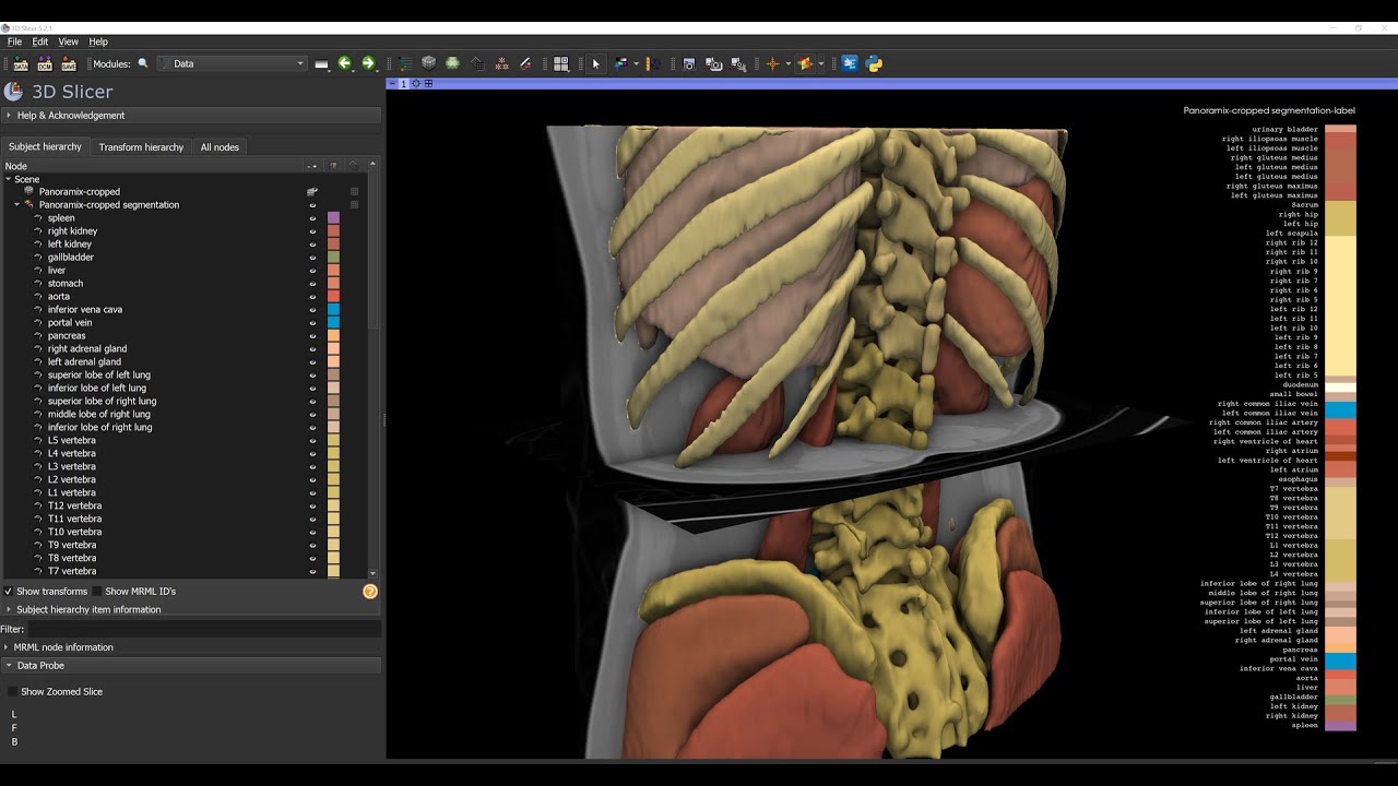Automatic whole-body CT segmentation in 2 minutes using 3D Slicer and TotalSegmentator