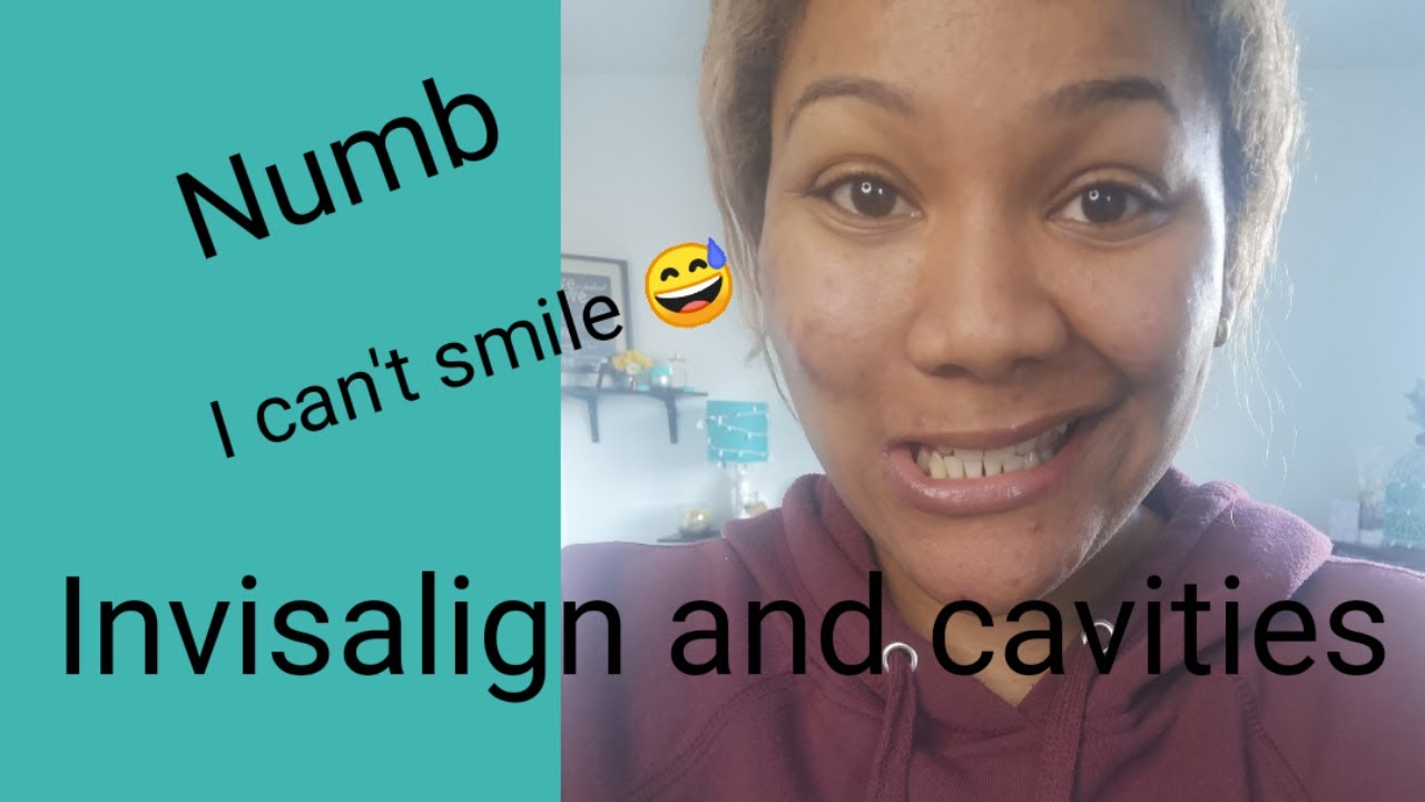 Invisalign and cavities | Getting new fillings while in invisalign treatment