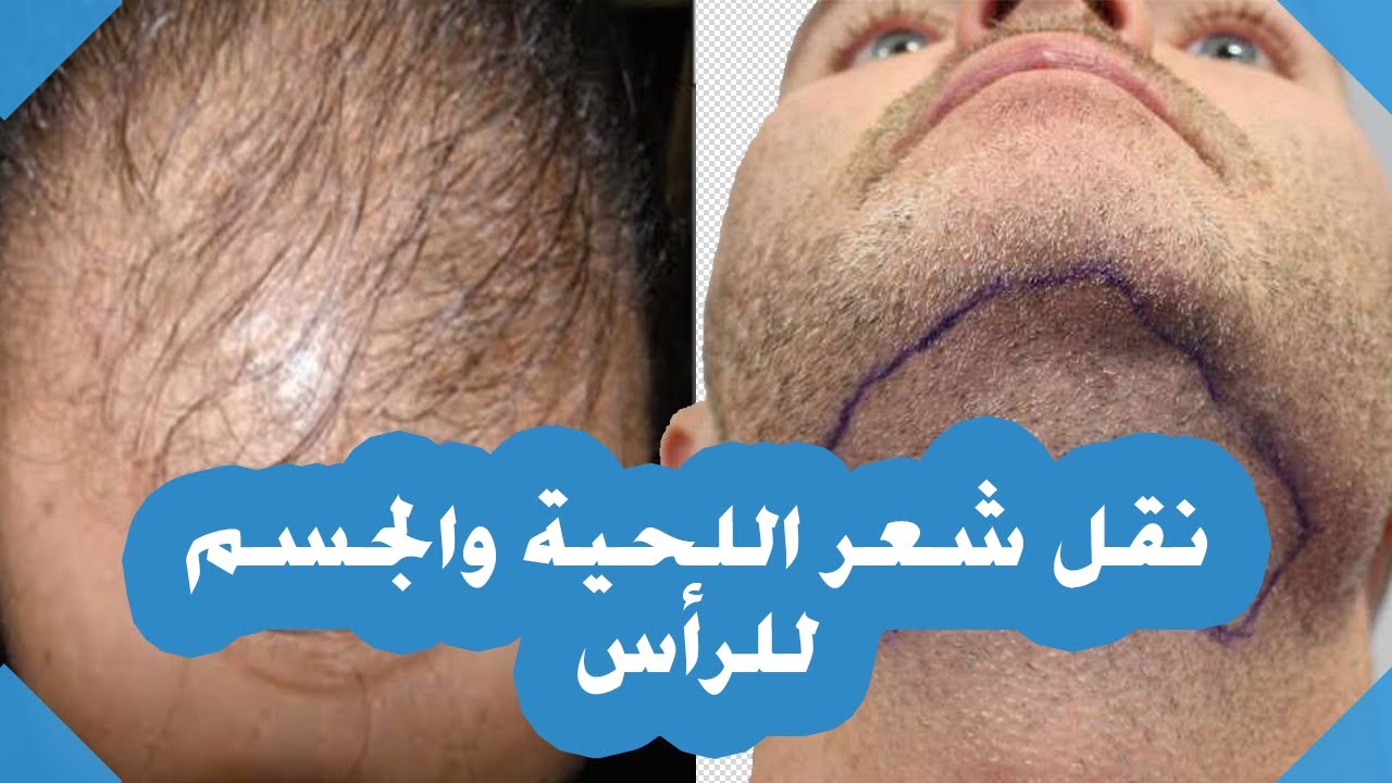 زراعة الشعر من شعر الجسم واستغلال اللحية في تكملة شعر الرأس تقنية BHT