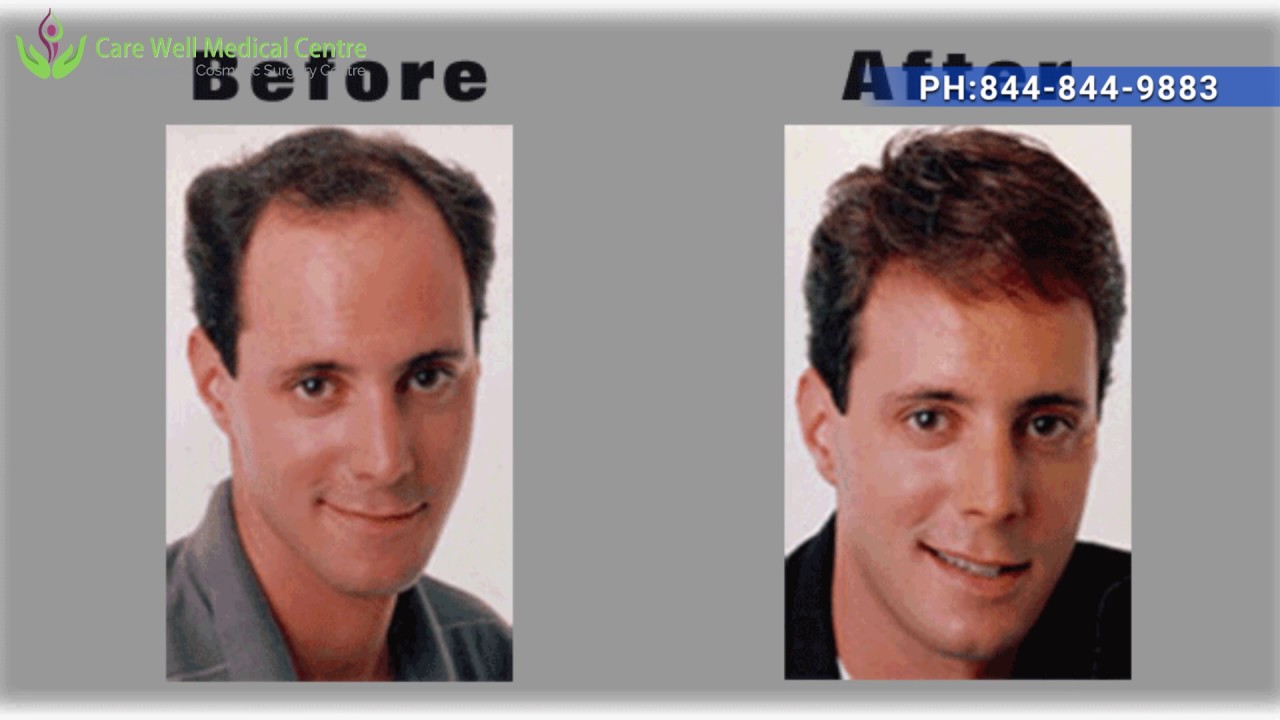 Hair Wigs in Delhi | Hair Weaving For Men | Care Well Medical Centre India
