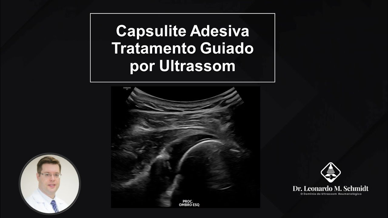 🎥 Tratamento de Capsulite Adesiva Guiado por Ultrassom