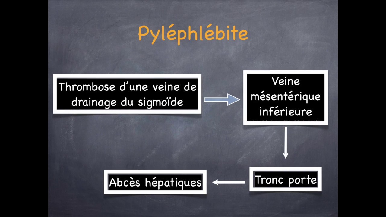 Diverticulose Colique et Sigmoïdite  - 2. Complications de la diverticulose