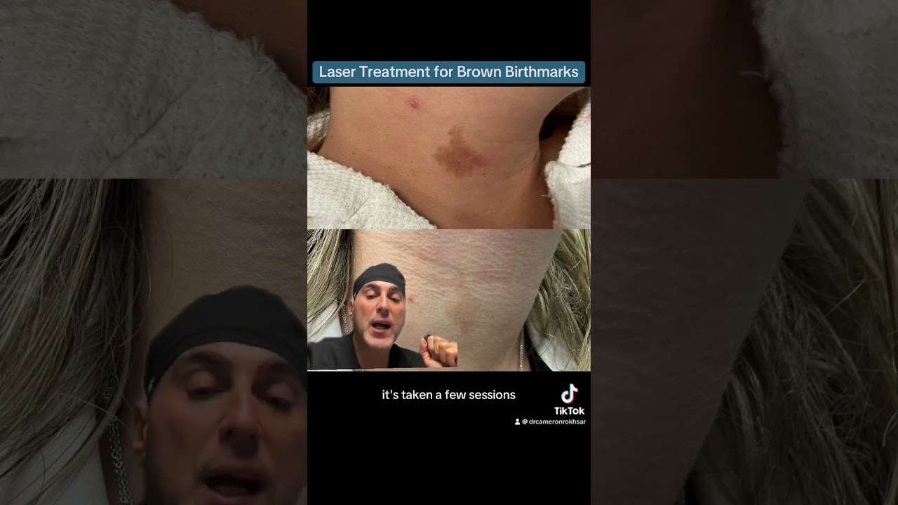 Laser Treatment of Brown Birthmarks