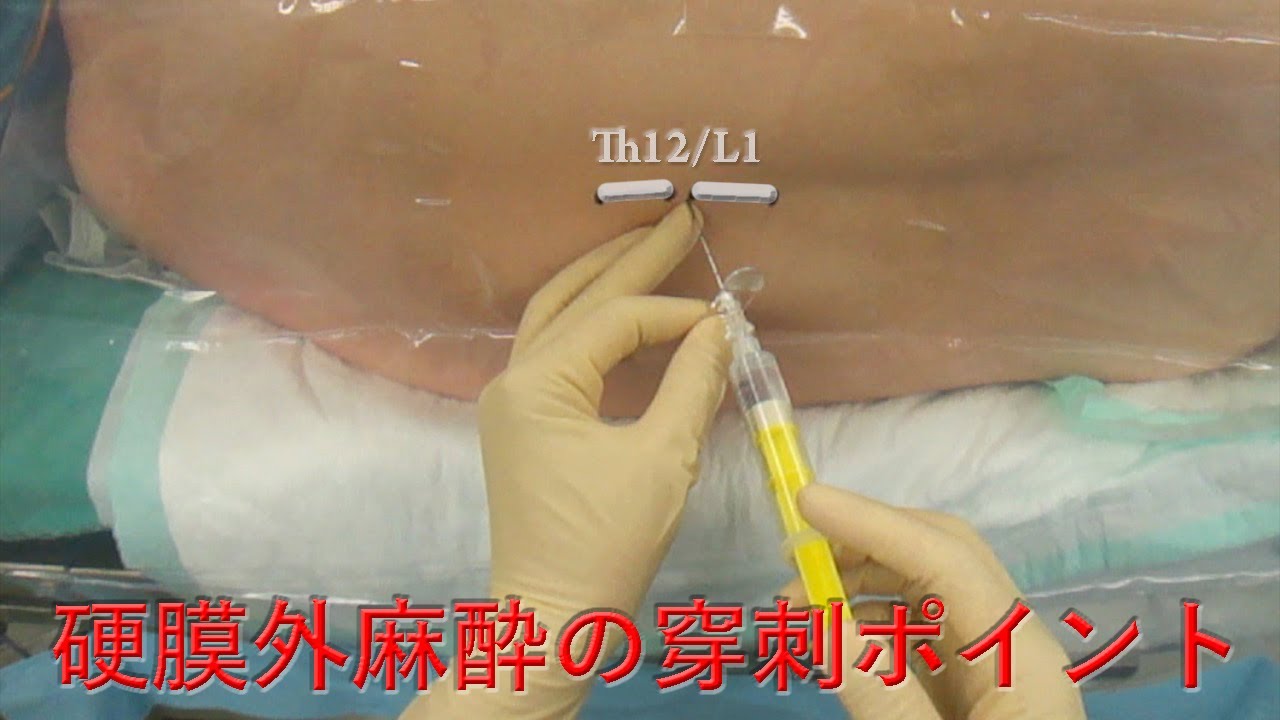 硬膜外麻酔穿刺ポイント Th12/L1 epidural anesthesia by Dr.EpiCal