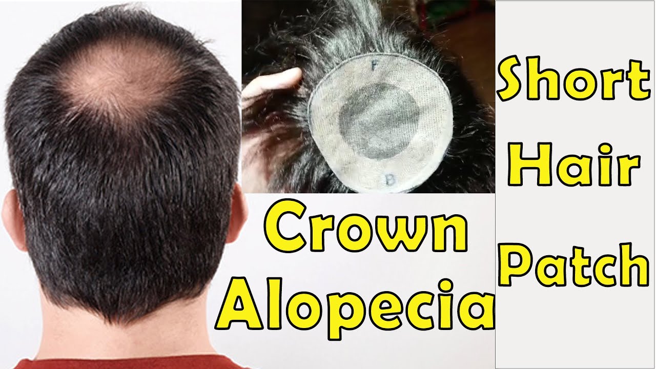 Crown Area Short Hair Patch [Hair Skill]