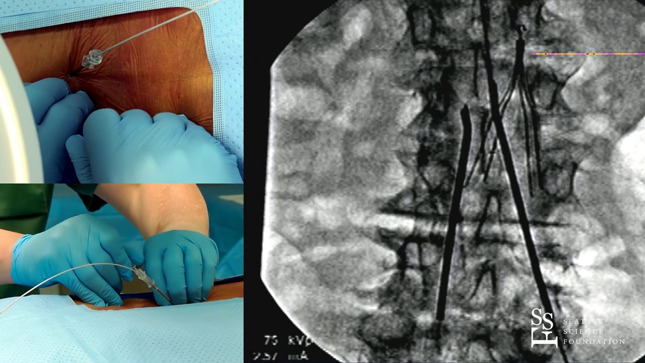 Spinal Cord Stimulation Procedure  Boston Scientific - Brett Stacy, MD