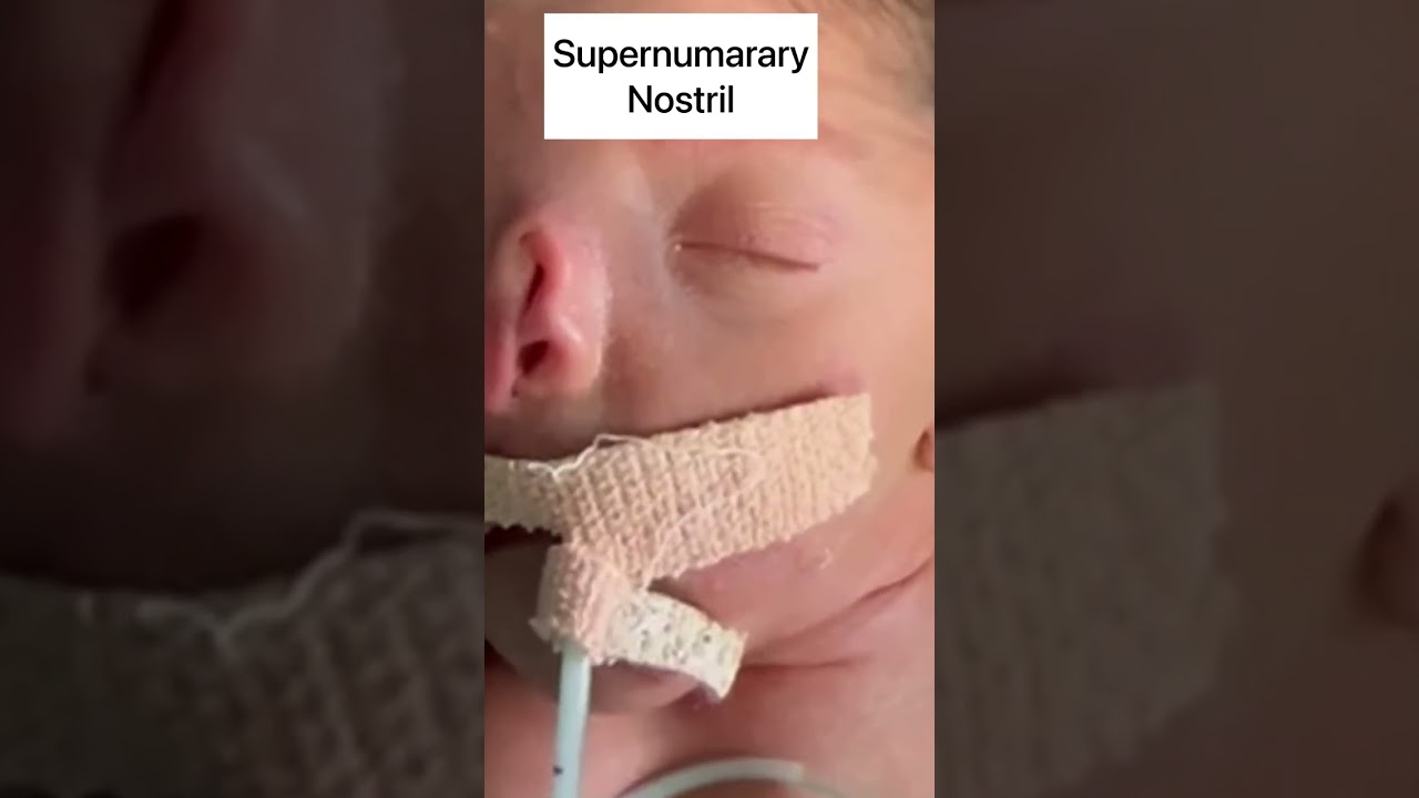 Newborn with supernumerary nostril & choanal atresia |the baby doctor |#newborn #shorts #rare