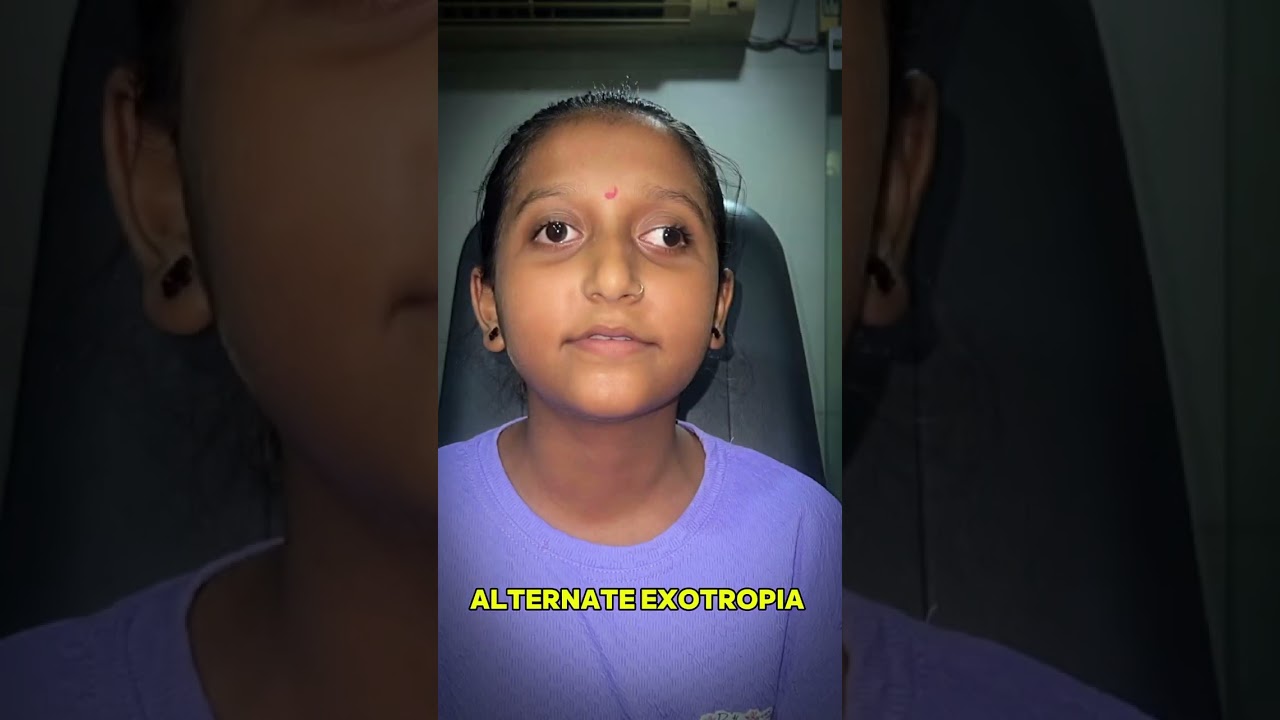 Truth About Squint Cross Eye Treatment  Glasses & Surgery Only &ndash; No Magic Cure