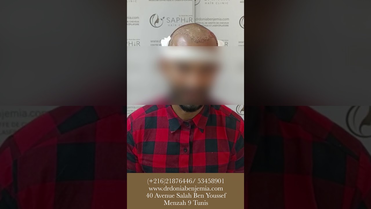 Greffe de cheveux en Tunisie meilleure densit&eacute; Saphir Hair Clinic Tunisia by Dr Donia Ben Jemia