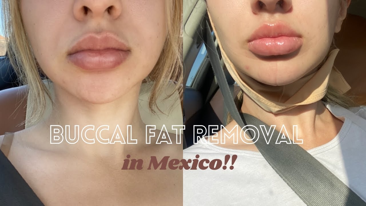 I GOT COSMETIC SURGERY IN MEXICO!!+ buccal fat removal Q&A