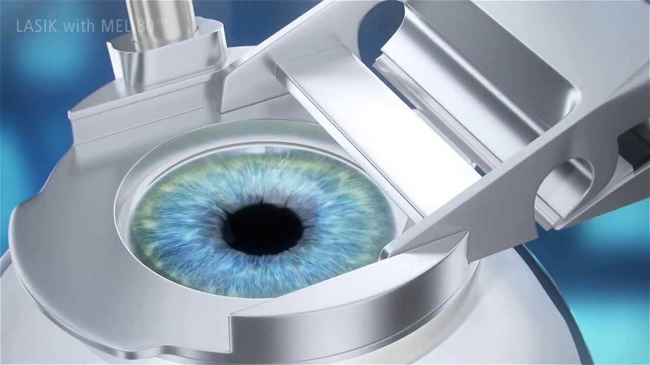ผ่าตัดแก้ไขสายตาผิดปกติด้วยเลเซอร์ : เลสิก (LASIK)