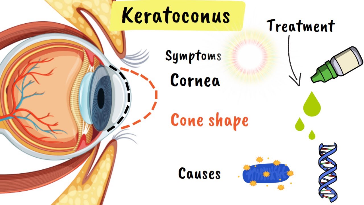Keratoconus Explained (When Your Cornea Changes Shape)