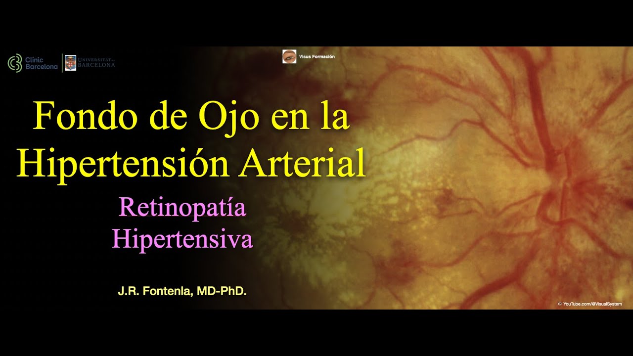 Fondo de Ojo en la Hipertensión Arterial. Retinopatía Hipertensiva.