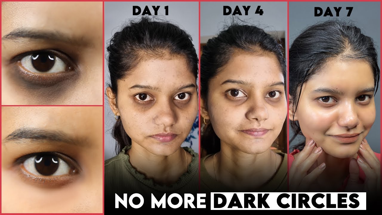 Get Rid of DARK CIRCLES Naturally in 7 Days | Permanent Solution of Dark Circle | Remove Dark Circle