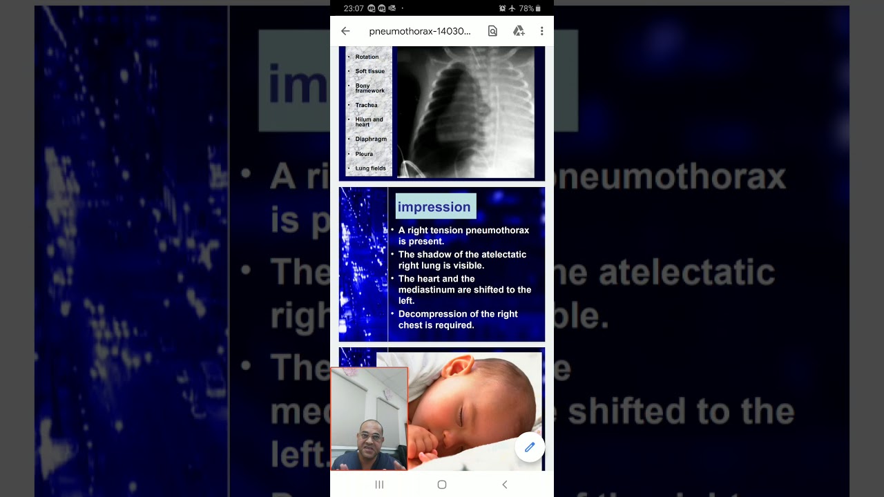 Case 1 how to suspect and diagnose pneumothorax?