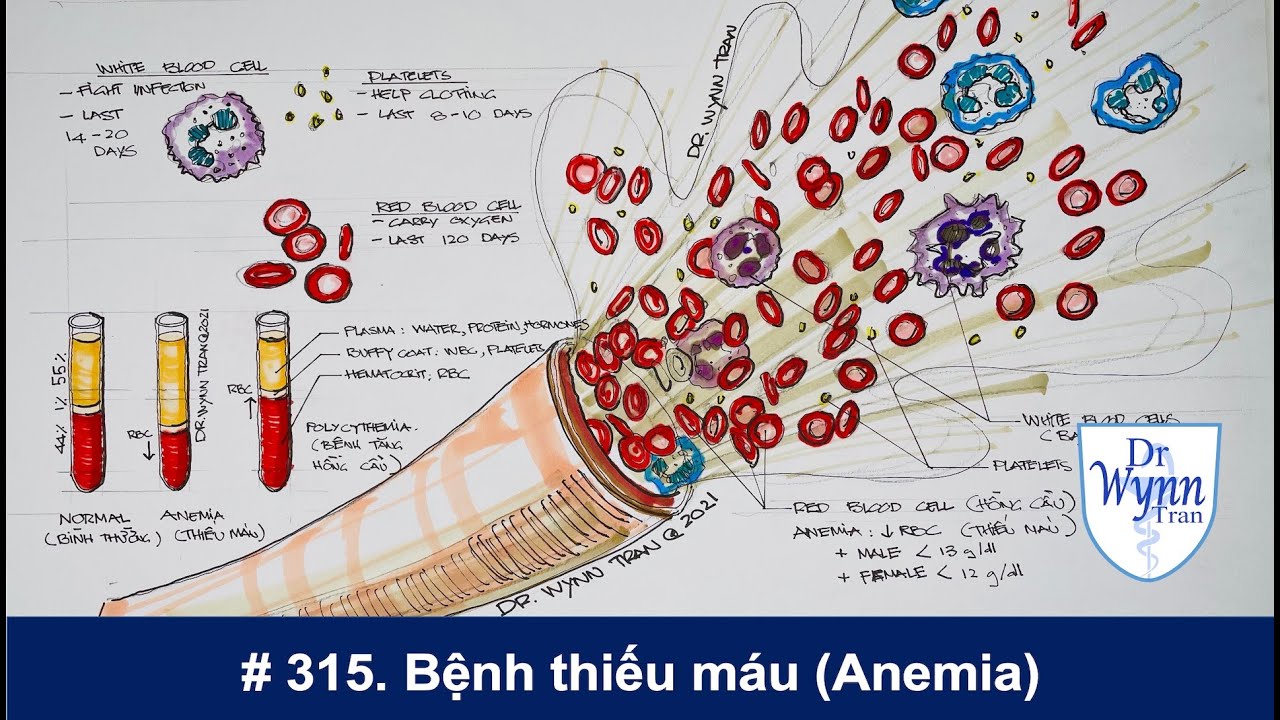 #315. Bệnh thiếu máu (Anemia): nguyên nhân và chữa trị