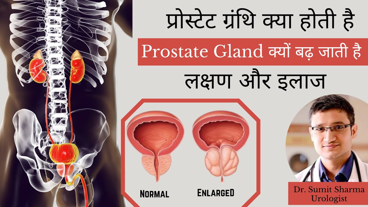 ✅ Prostate ग्रंथि क्या होती है - प्रोस्टेट बढ़ने के कारण, लक्षण और इलाज - Prostate Gland in Hindi