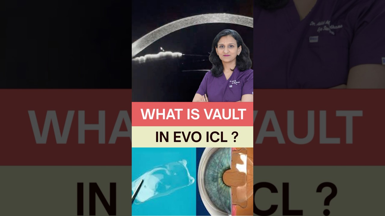 What is the Vault in EVO ICL? #evoicl #visianicl #ipcl  #clioeyecare