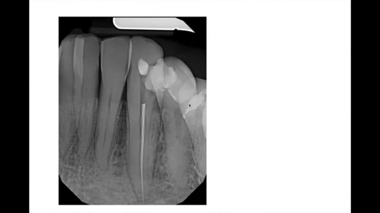 Broken Instrument Removal