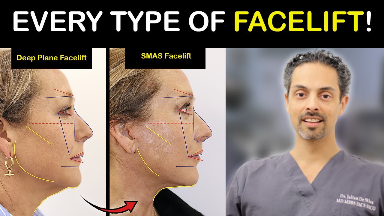 Facelift & Neck lift Scars - The Good, The Bad, The Ugly