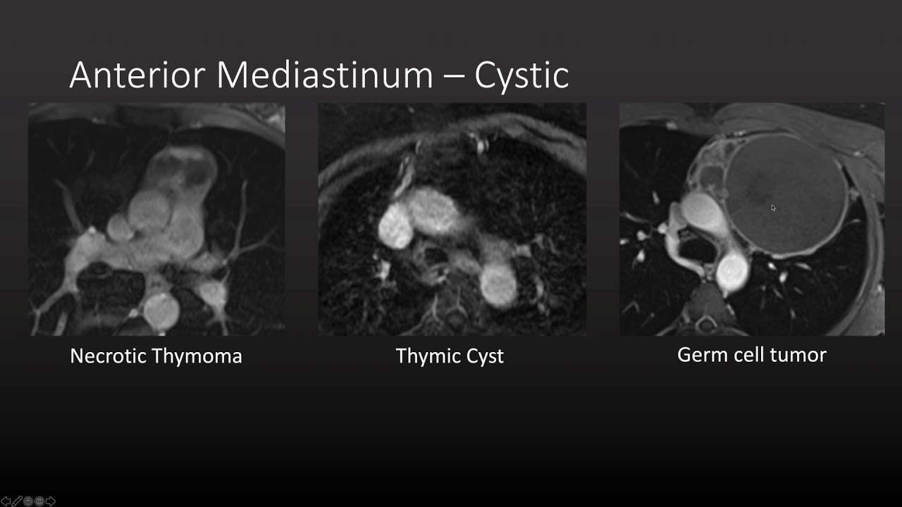 Approach to Mediastinal Masses