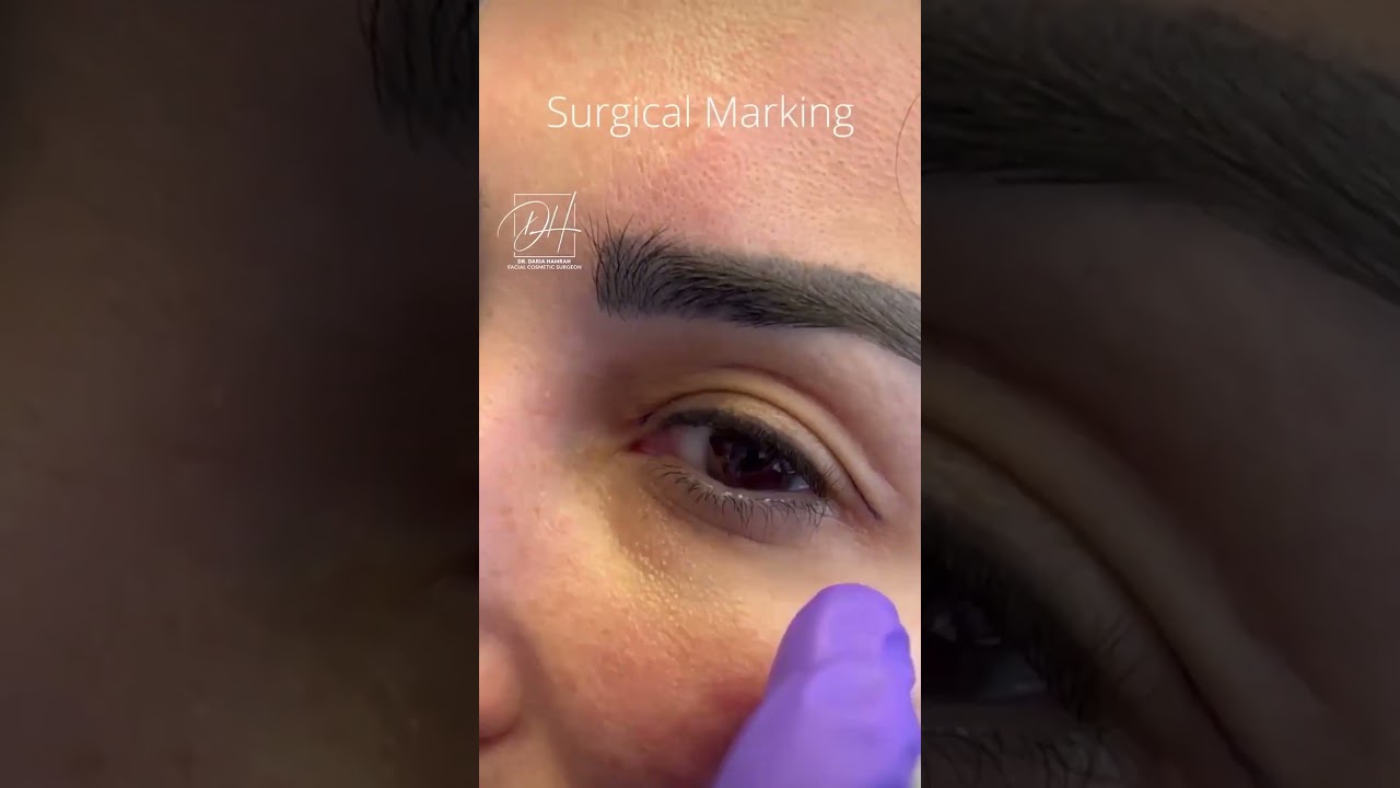 Eyelid Surgery for Hooded Eyes #hoodedeyemakeup #cosmeticsurgery #eyelidsurgery