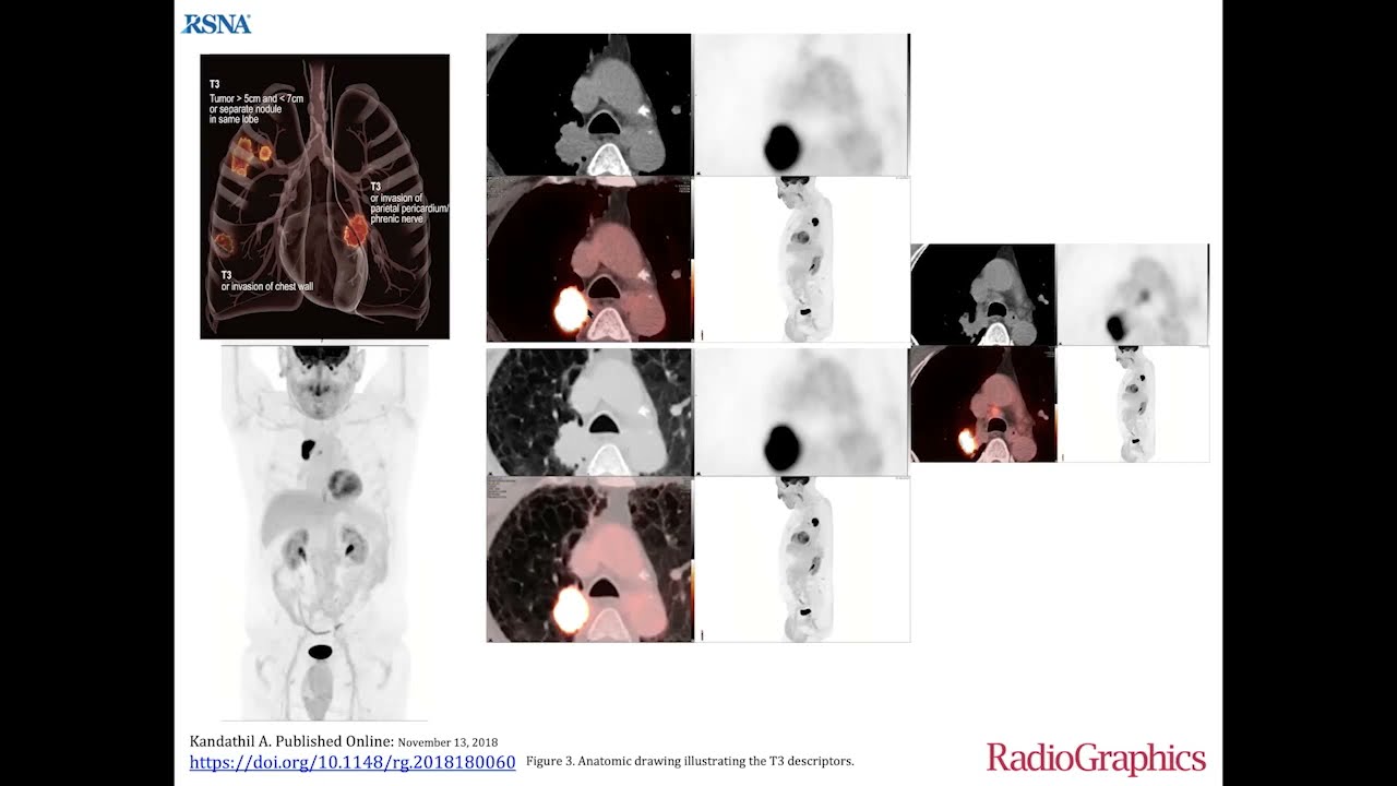 PET CT in lung carcinoma