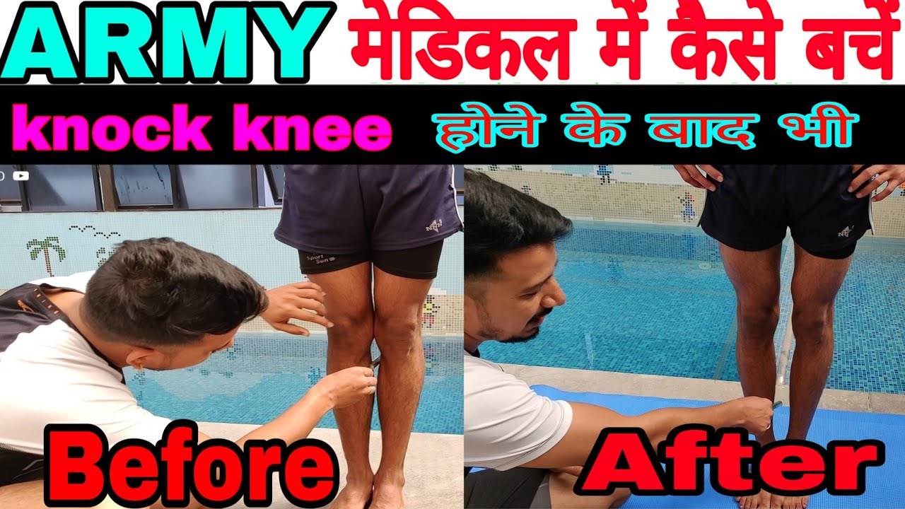 आर्मी मेडिकल में कैसे बचे Knock knee  होने के बावजूद भी  जानिए आसान तरीका