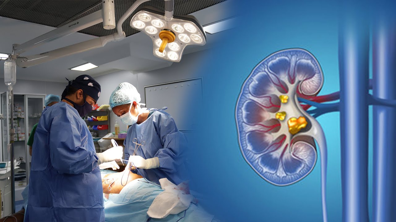 Successful Kidney Stones Removal Procedure| Nyembo  Adelle - DRC| Dr. Naveen Acharya