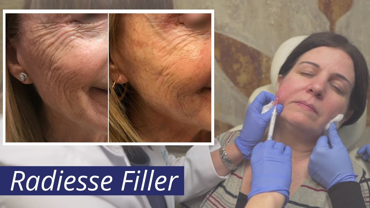 Radiesse Filler [Calcium Hydroxylapatite (CaHA) Injections]