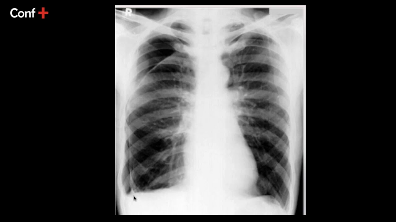 Cas d'imagerie (pneumothorax droit non compressif)