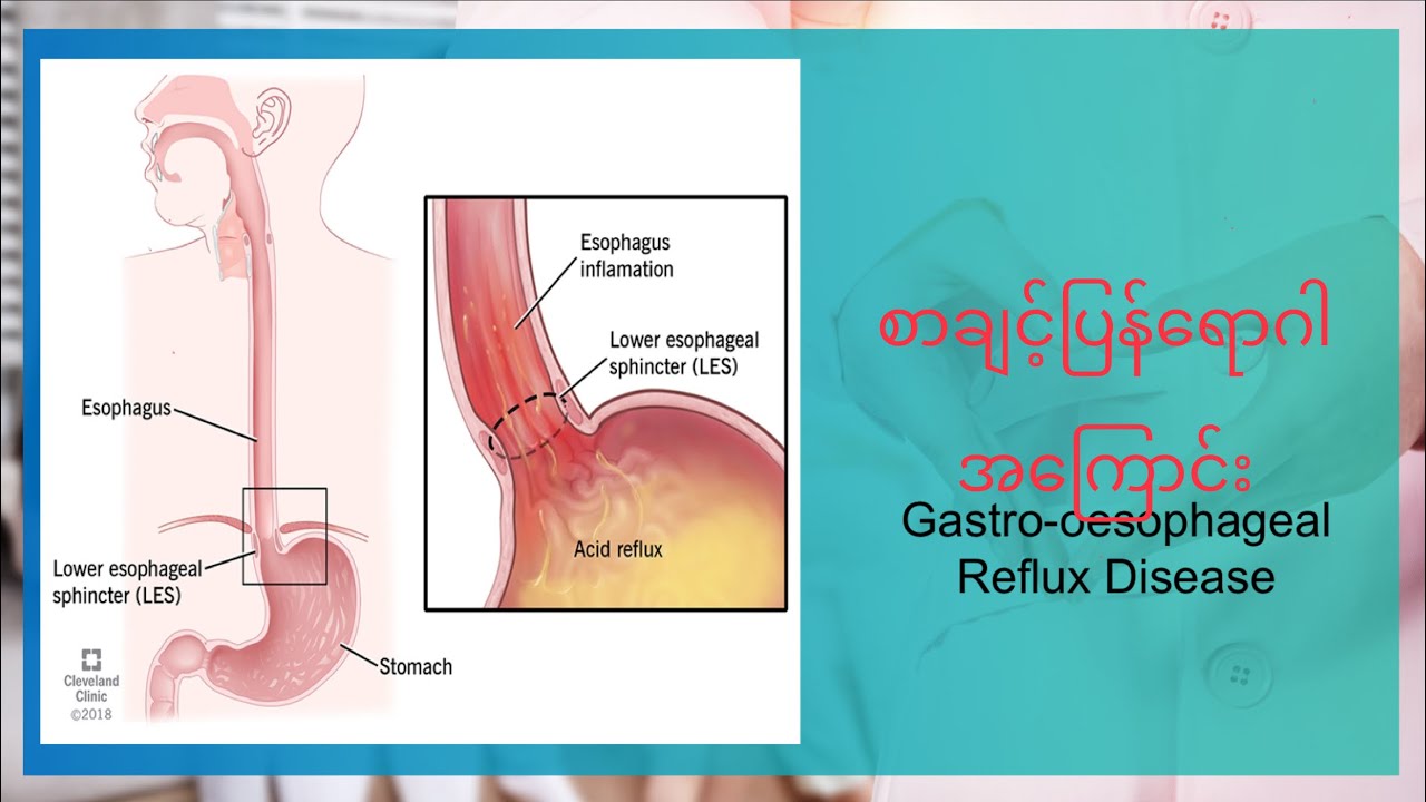 GERD စာချင့်ပြန်ရောဂါအကြောင်း သိကောင်းစရာ #healthknowledge