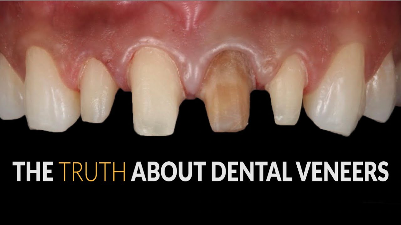 Bad Dental Veneers | Cosmetic Dentist Destroy Teeth| No Regret Smile Makeover By Brighter Image Lab