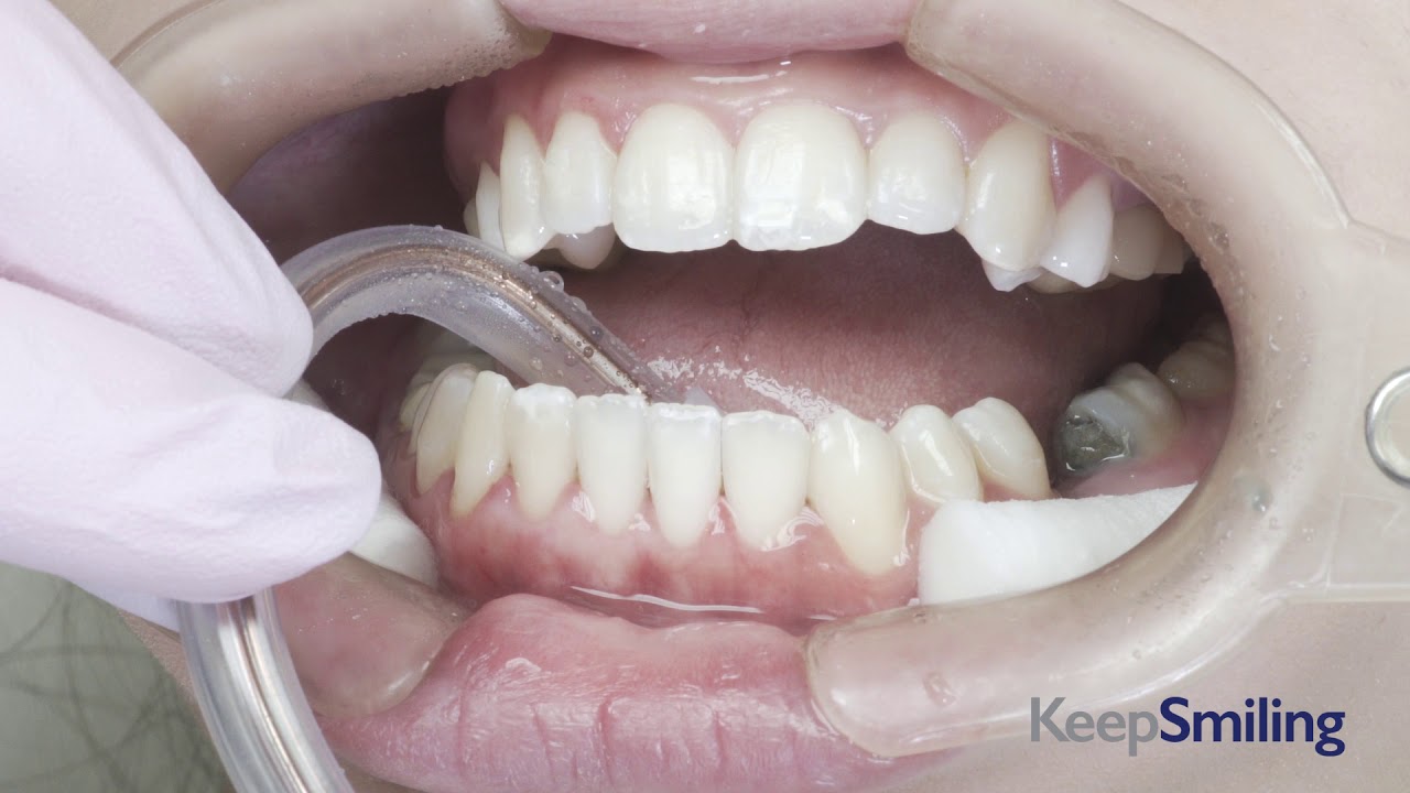 Colocación de attachment - KeepSmiling Ortodoncia Invisible