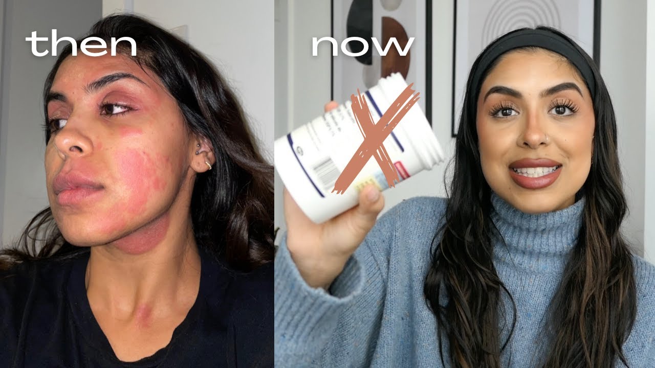 how i naturally healed my chronic eczema in 8 months | diet, routine, holistic healing, skincare etc