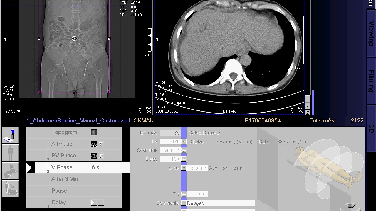 how to make ct scan of Whole abdomen (SIEMENS) in syngo acquisition workplace..