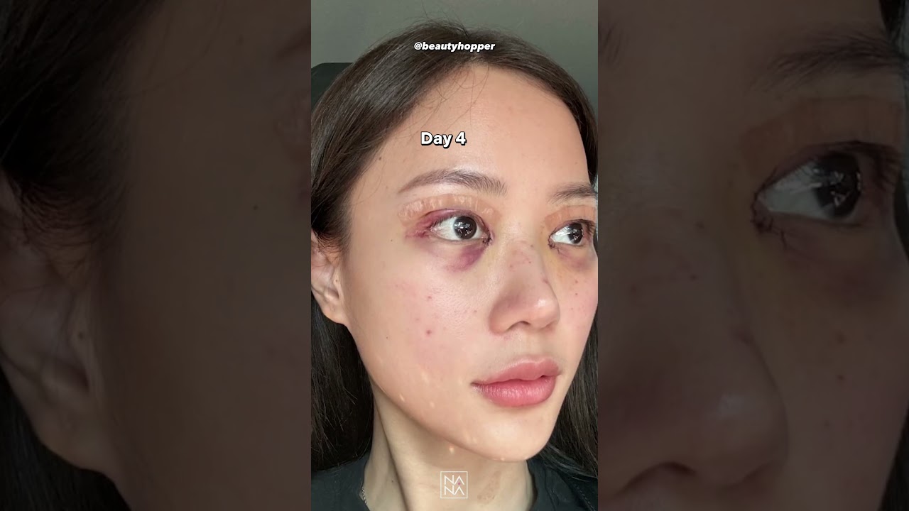 double eyelid surgery 1 month recovery process! #plasticsurgeryinkorea