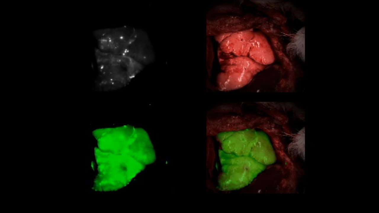 Intraoperative Subpleural Lung Tumor Margin Visualization Using Indocyanine Green Inhalation