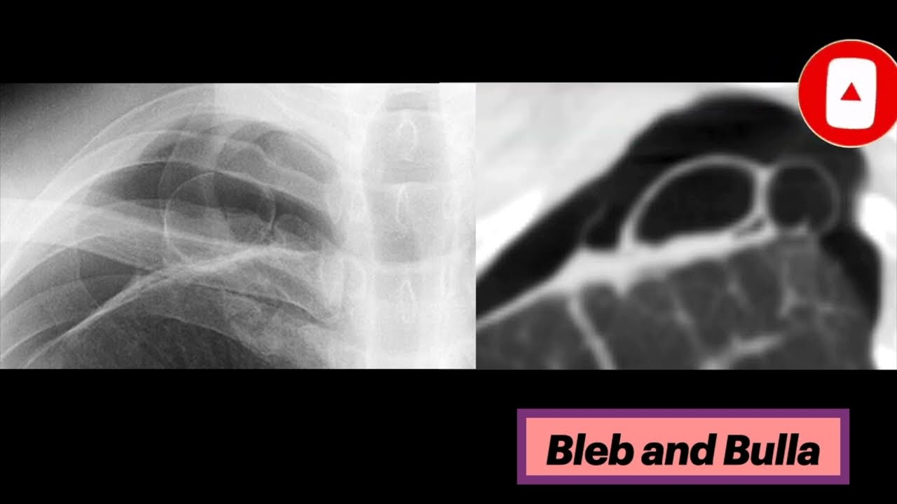 Blebs and Bullae #radiology #thoracicsurgery #pulmonology