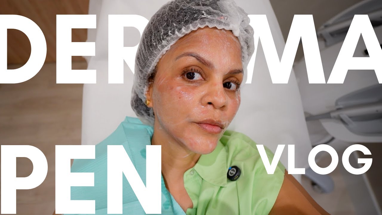 Mi PRIMERA sesión de DERMAPEN para manchas! 😘