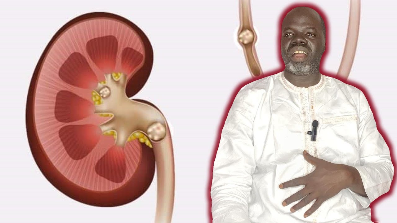👨‍⚕️Calculs rénaux #2: ( Prevention et Solutions ) - Pr Ousmane Ndiaye - SAMA XALAAT TV