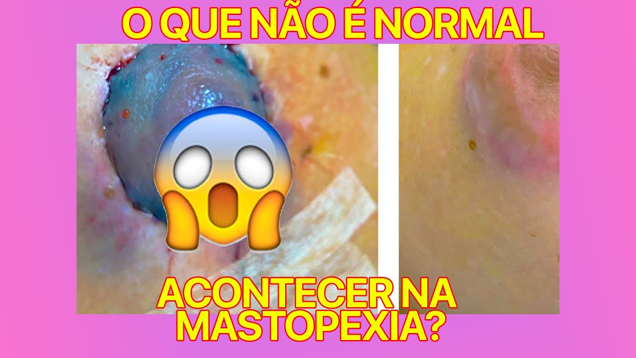 O QUE NÃO É NORMAL DE ACONTECER APÓS A MASTOPEXIA? CIRURGIA PLÁSTICA
