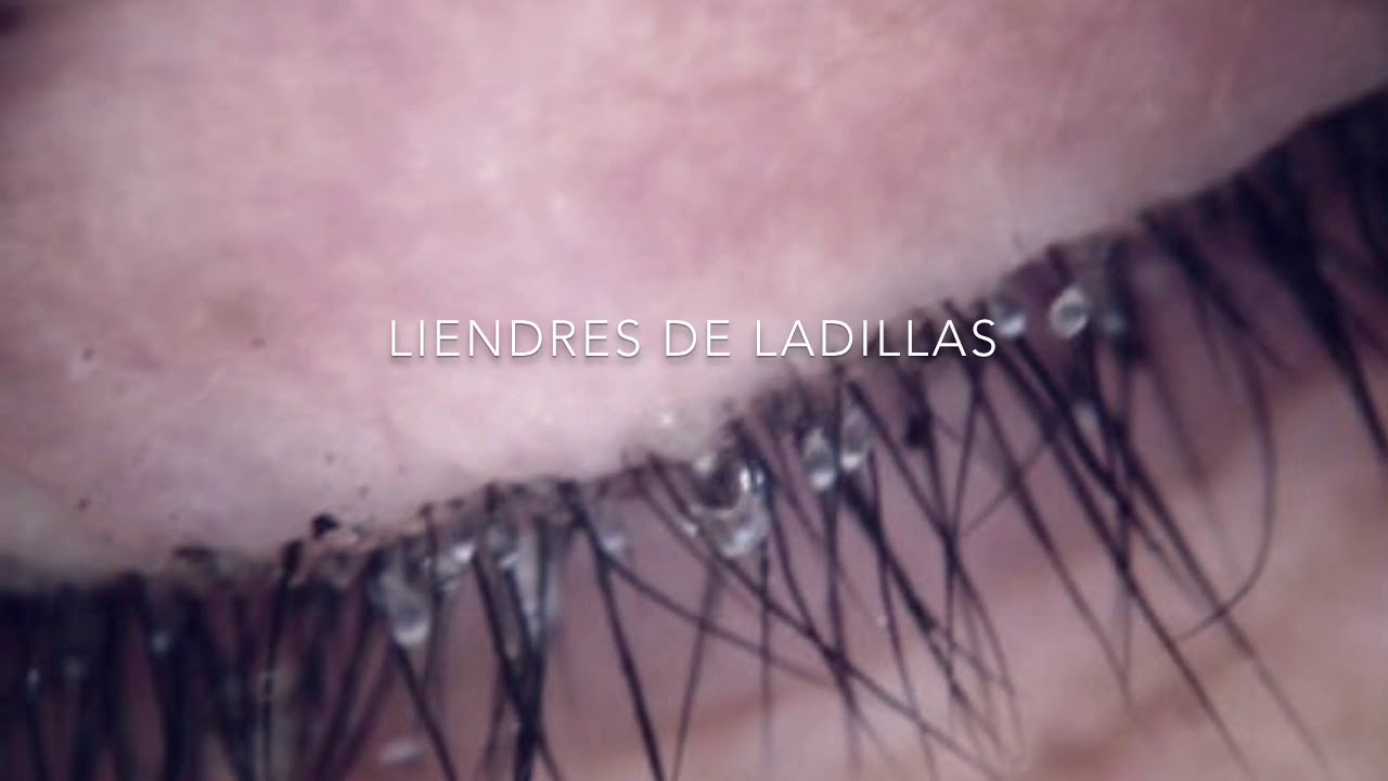 Diferencia entre Piojos Púbicos Y Piojos De La Cabeza