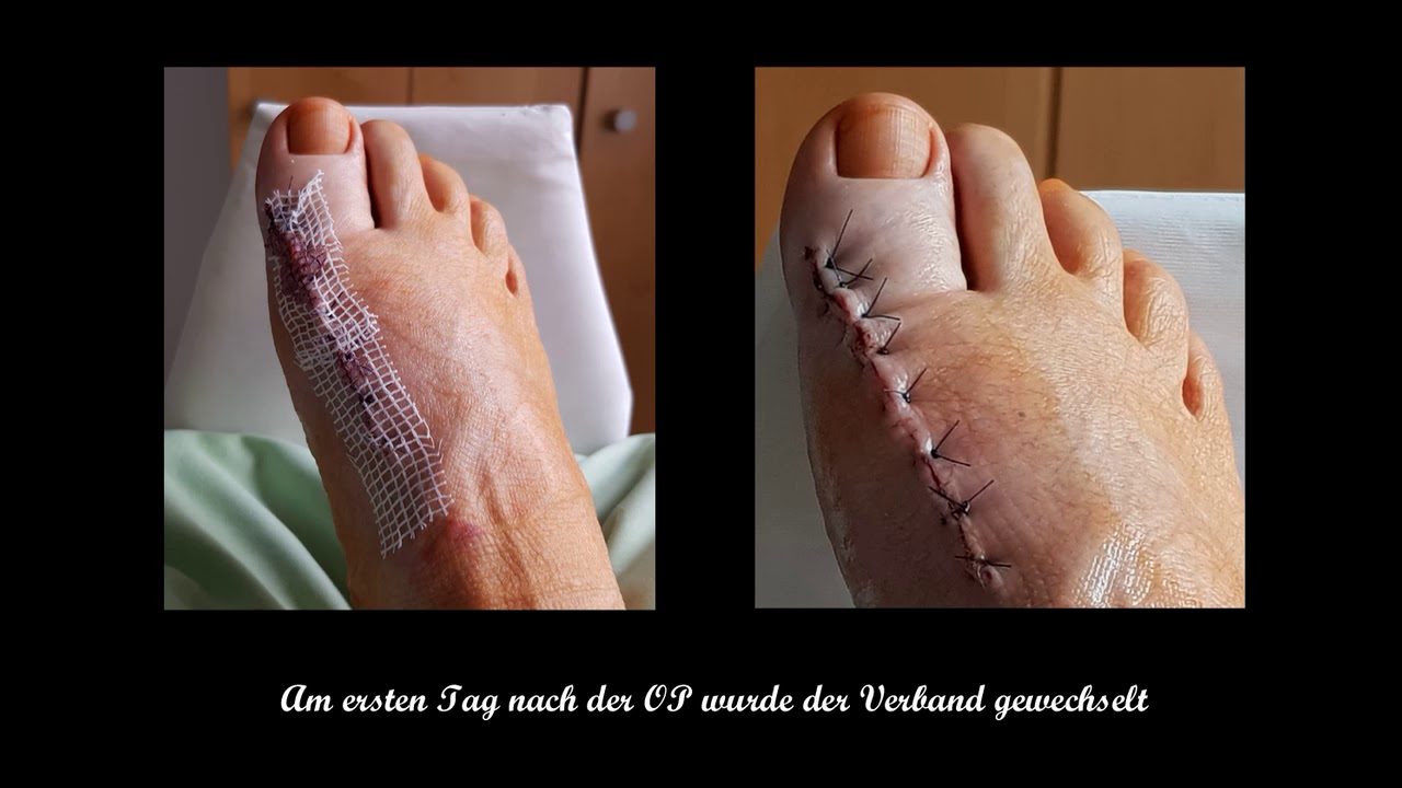Hallux Rigidus -  Meine OP am Großzehengrundgelenk