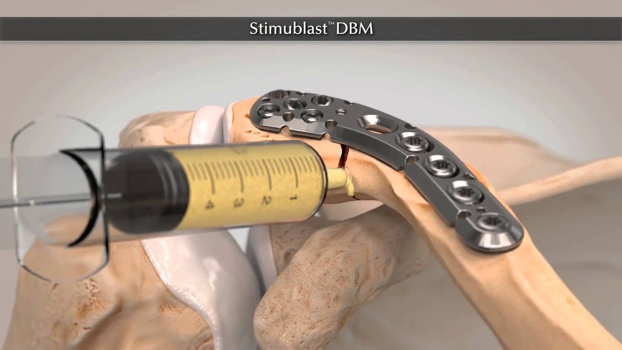 StimuBlast&reg; Demineralized Bone Matrix (DBM)