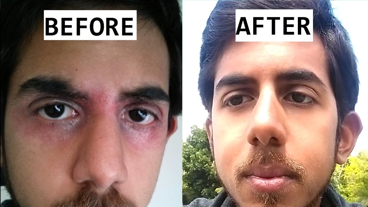 What is a Healing Crisis | Detoxification Crisis??